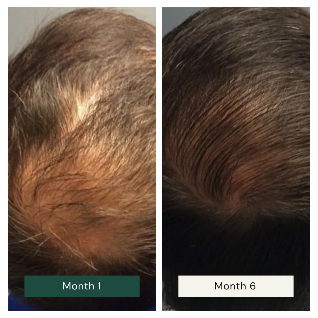 RootGlow™ Red Light Therapy Scalp Brush